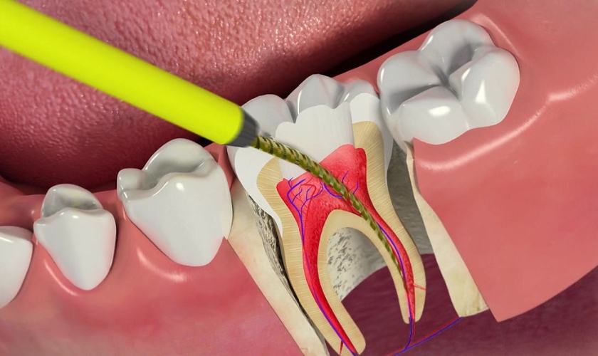 root-canal-therapy