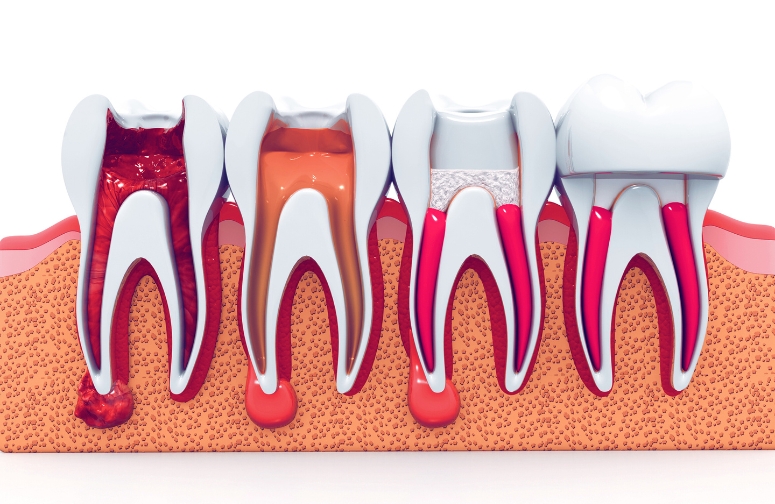 how long does a root canal last